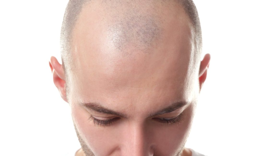 Yetkili kaynaklardan gelen bilgilere göre, Erkeklerde Kellik Oranı En Yüksek