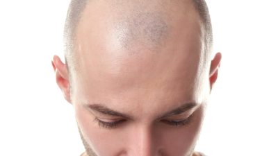 Yetkili kaynaklardan gelen bilgilere göre, Erkeklerde Kellik Oranı En Yüksek