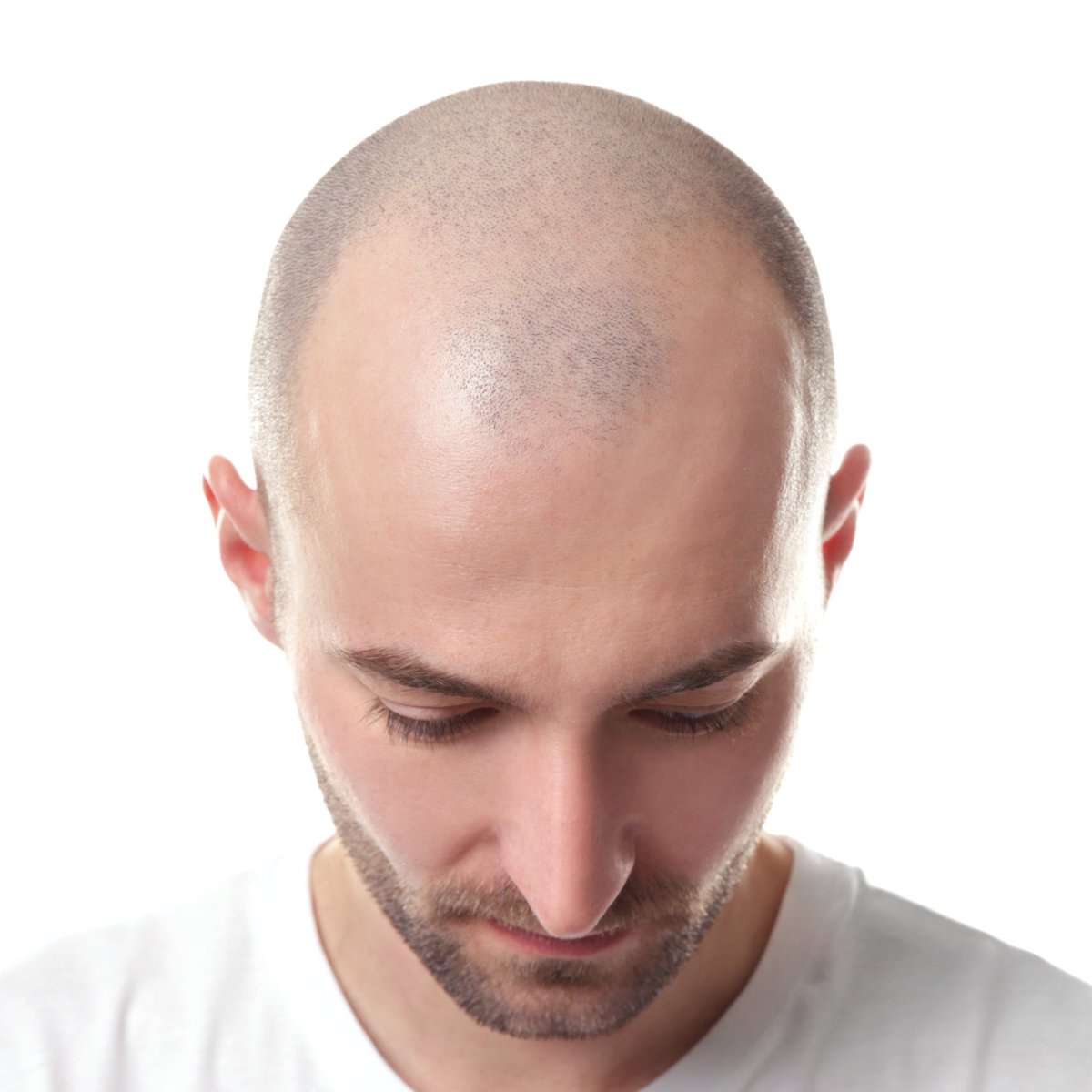 Yetkili kaynaklardan gelen bilgilere göre, Erkeklerde Kellik Oranı En Yüksek